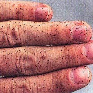 Bird Lice Control in Lovemore park
